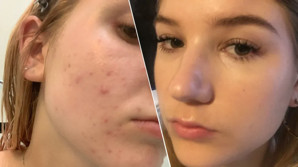 Accutane