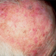 Actinic Keratosis