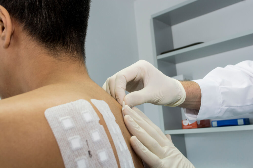 Allergy Patch Testing