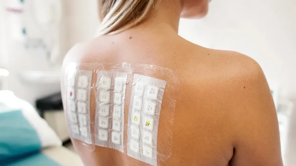 Allergy Patch Testing