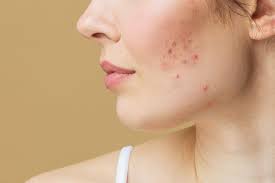 Cystic Acne 