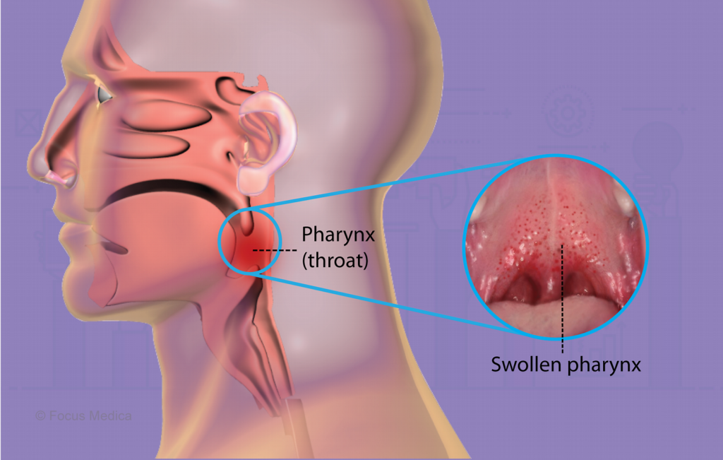 Sore Throat